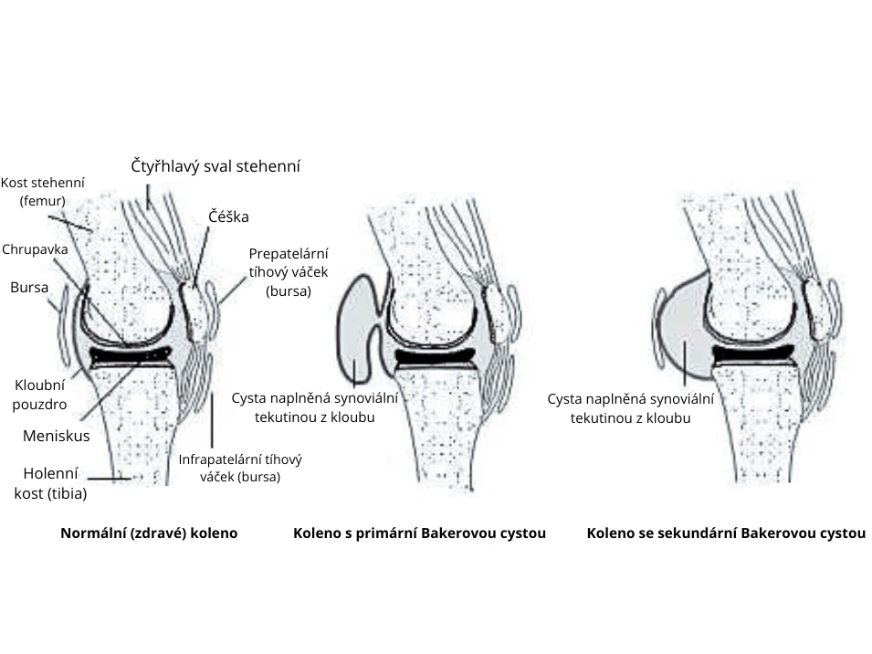Bakerova cysta - Fotka
